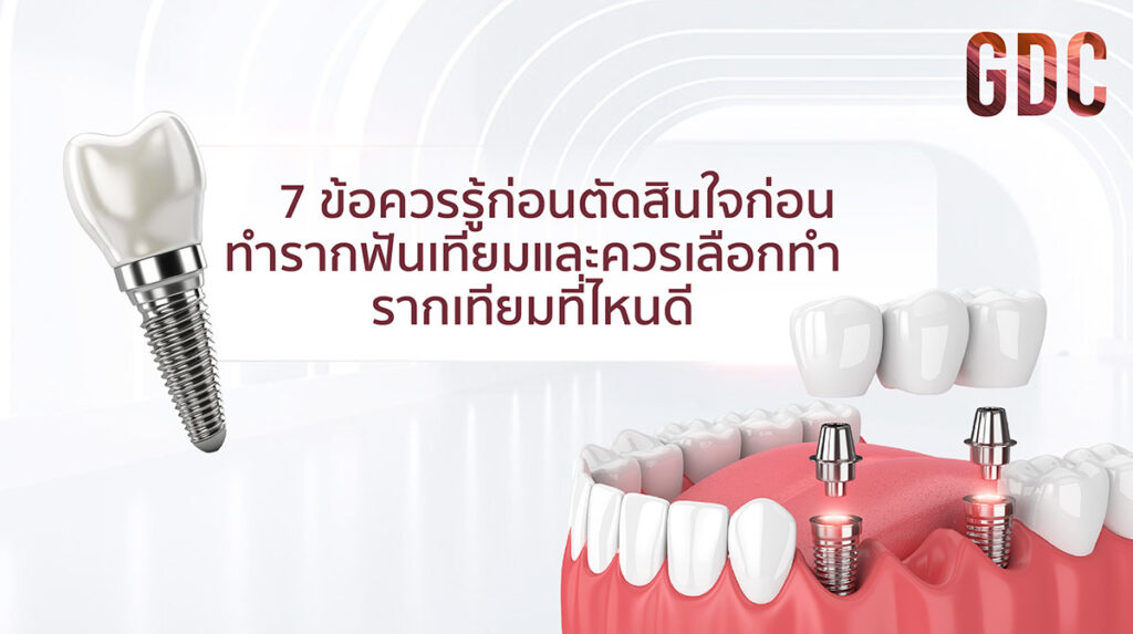 ทำรากฟันเทียม ที่ไหนดี