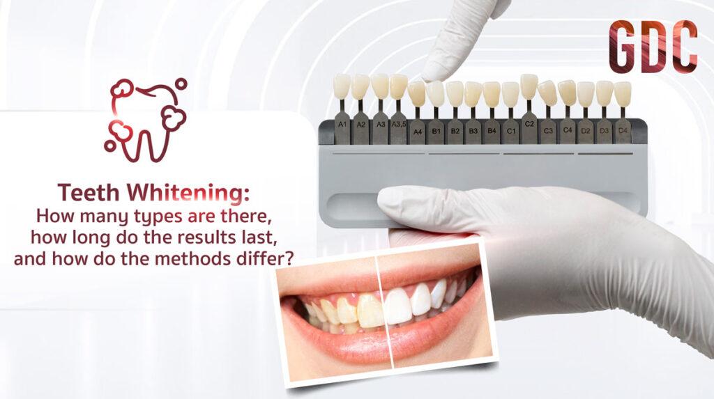 Teeth Whitening Types