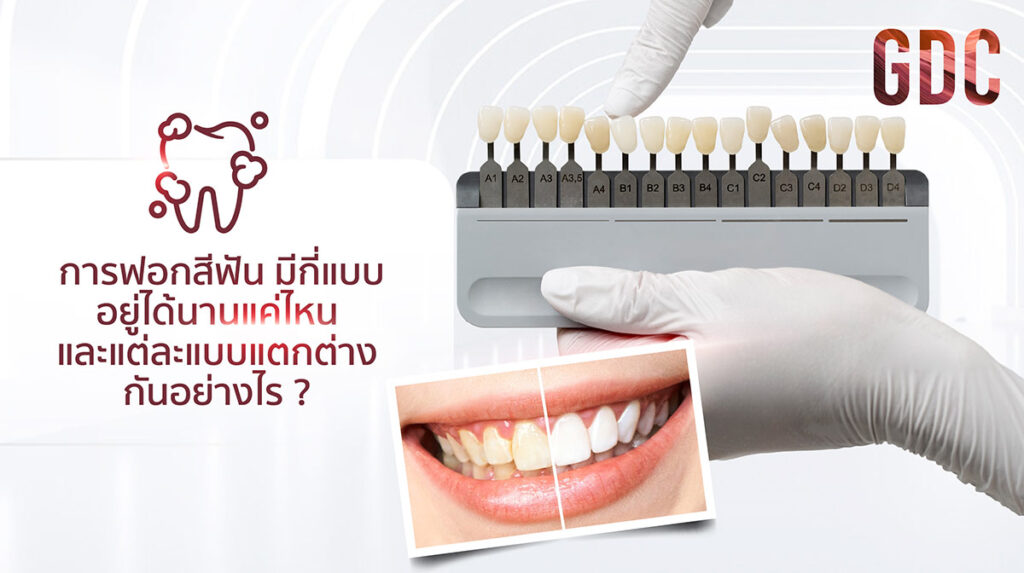 การฟอกสีฟัน มีกี่แบบ