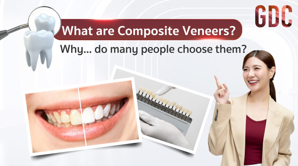 Composite Veneers
