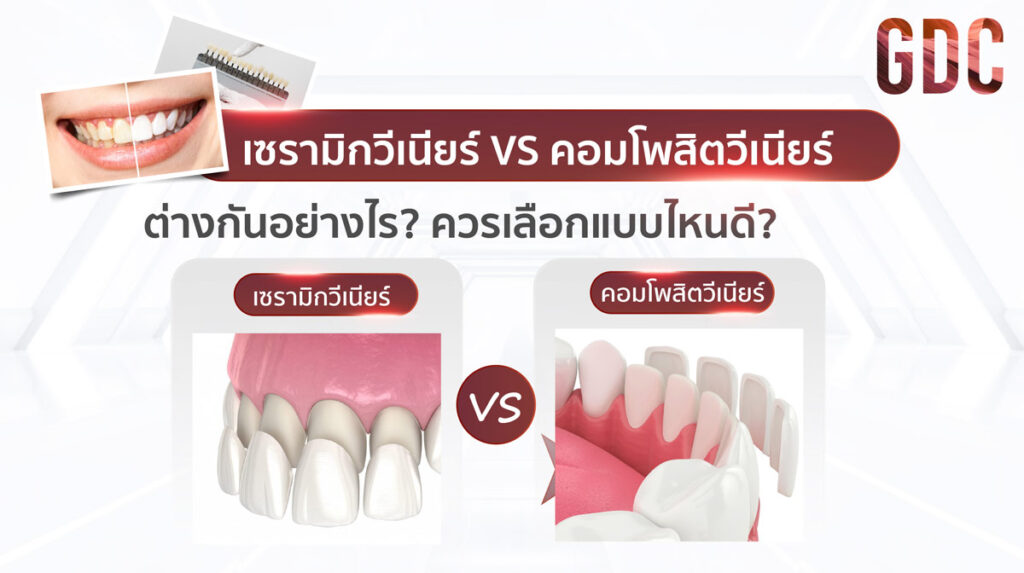 เซรามิกวีเนียร์