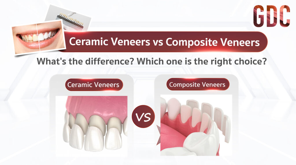 Ceramic Veneers